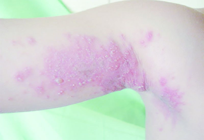 Kissing lesions on the axilla studded with pustules and vesicles often seen from the spread of pederin to adjacent skin surfaces