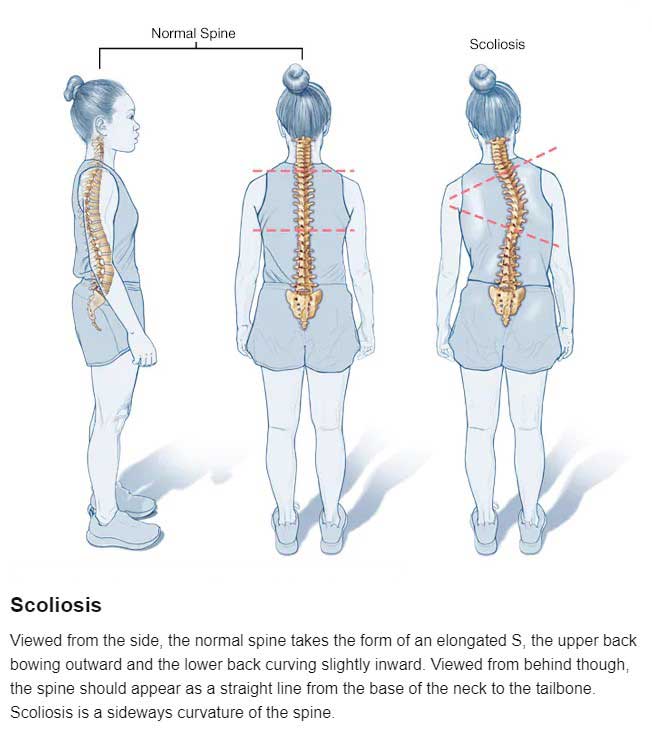 Scoliosis is a type of spinal deformity.