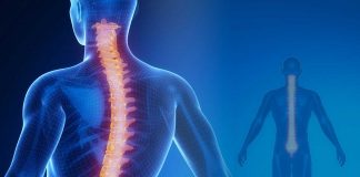 Scoliosis is a sideways curvature of the spine that most often is diagnosed in adolescents