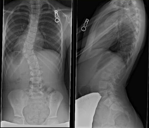 How is scoliosis diagnosed?