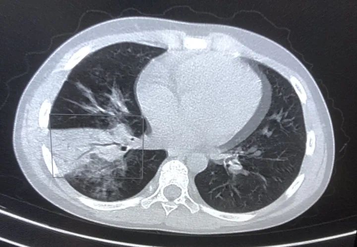 Mycoplasma pneumonia infections 2
