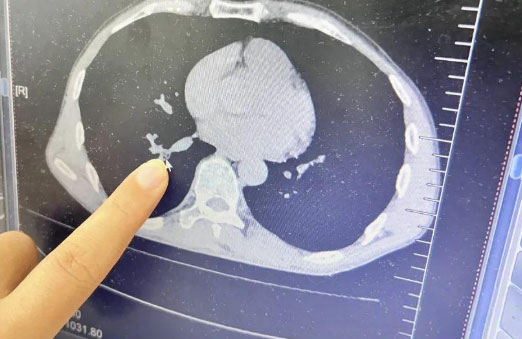 58-Year-Old Man Discovers Cockroach in His Trachea After Days of Discomfort