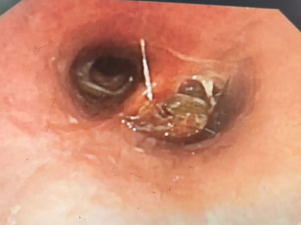 58-Year-Old Man Discovers Cockroach in His Trachea After Days of Discomfort