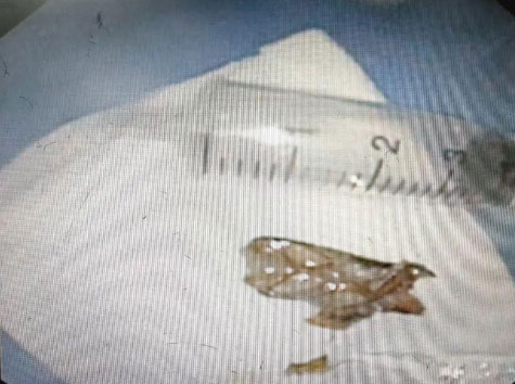 58-Year-Old Man Discovers Cockroach in His Trachea After Days of Discomfort